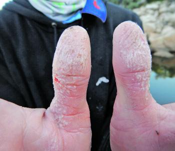 Catching and handling a bunch of cod can result in sore thumbs.